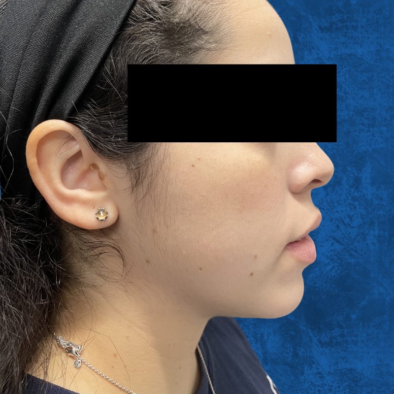 Profile view of a person's face against a dark blue background, highlighting jawline and facial features.