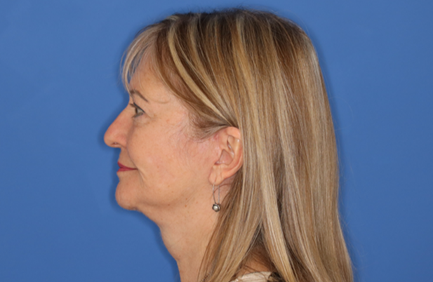 65 year old female underwent deep plane face and neck lift