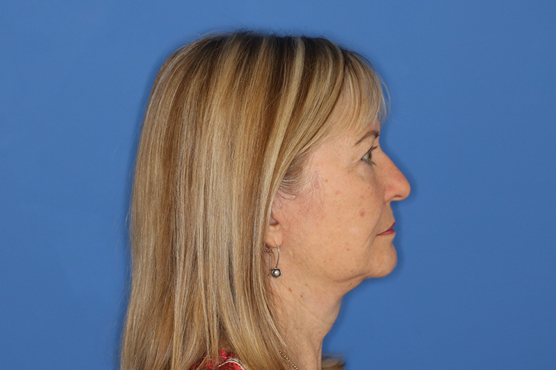 65 year old female underwent deep plane face and neck lift