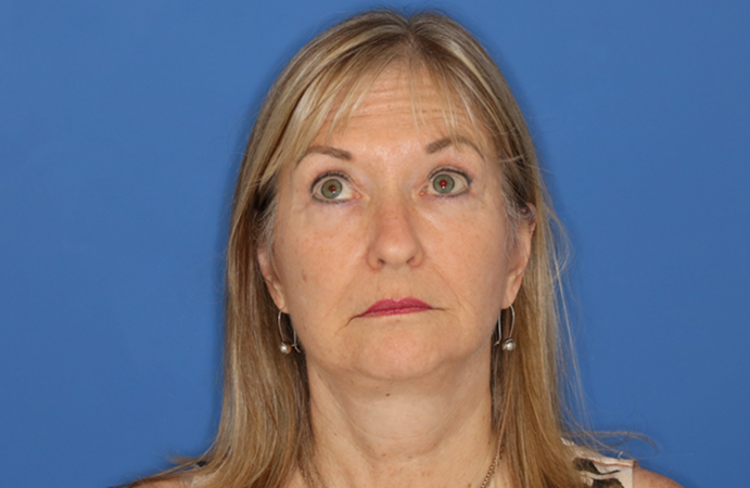 65 year old female underwent deep plane face and neck lift