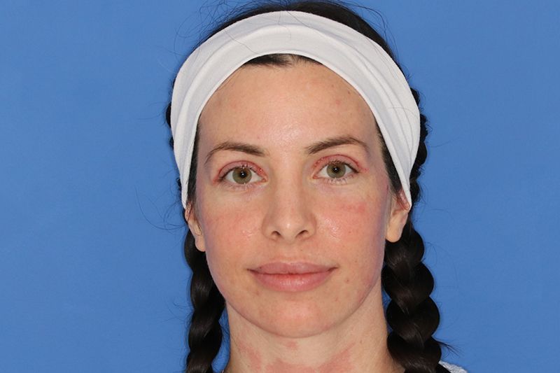 After image of a 29 year old female who underwent bilateral upper blepharoplasty at Carson Williams Facial Plastic Surgery