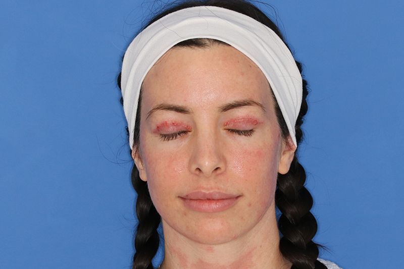 58 year old man who underwent bilateral upper blepharoplasty in office under local anesthesia