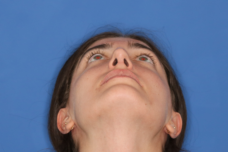 Close up image of a woman's face after rhinoplasty surgery at Carson Williams MD Facial Plastic Surgery office in Leawood KS