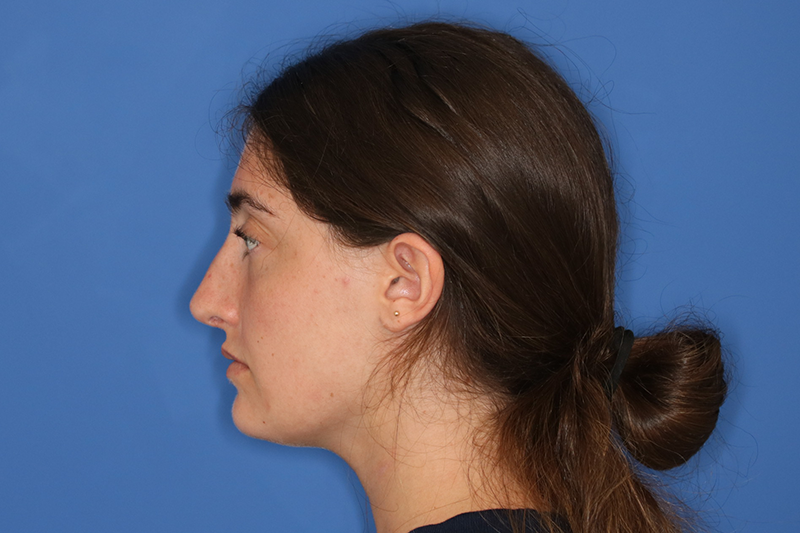 Close up image of a woman's face after rhinoplasty surgery at Carson Williams MD Facial Plastic Surgery office in Leawood KS