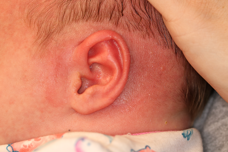 Close up of an infant's ear after EarWell Infant Ear Molding at Carson Williams Facial Plastic Surgery in Leawood, KS
