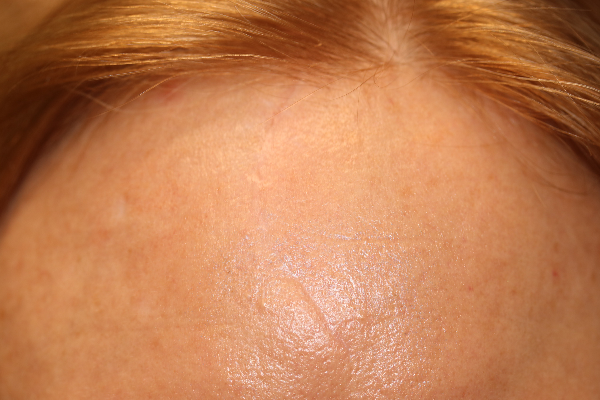 An after picture of a woman who underwent scar treatment at Carson Williams MD Facial Plastic Surgery in leawood, KS