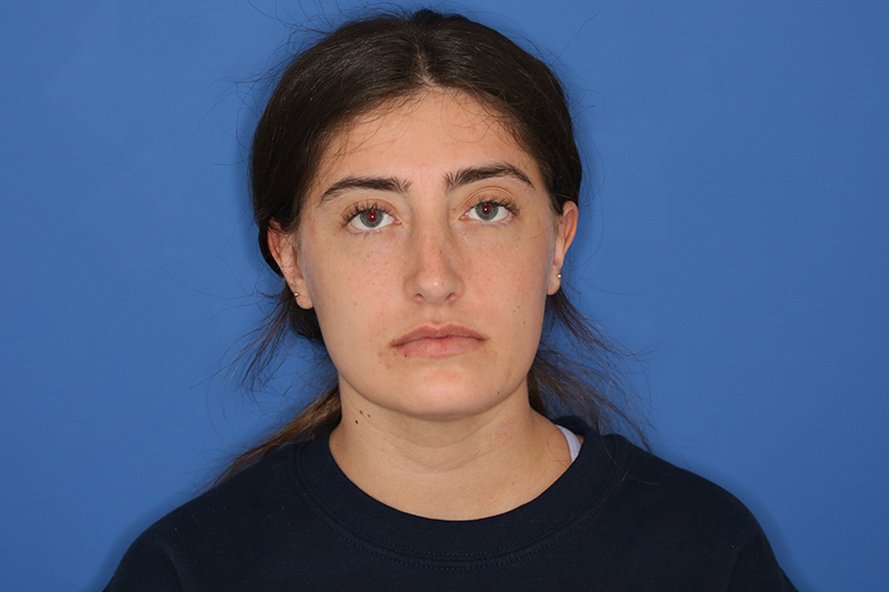 Close up image of a woman's face after rhinoplasty surgery at Carson Williams MD Facial Plastic Surgery office in Leawood KS