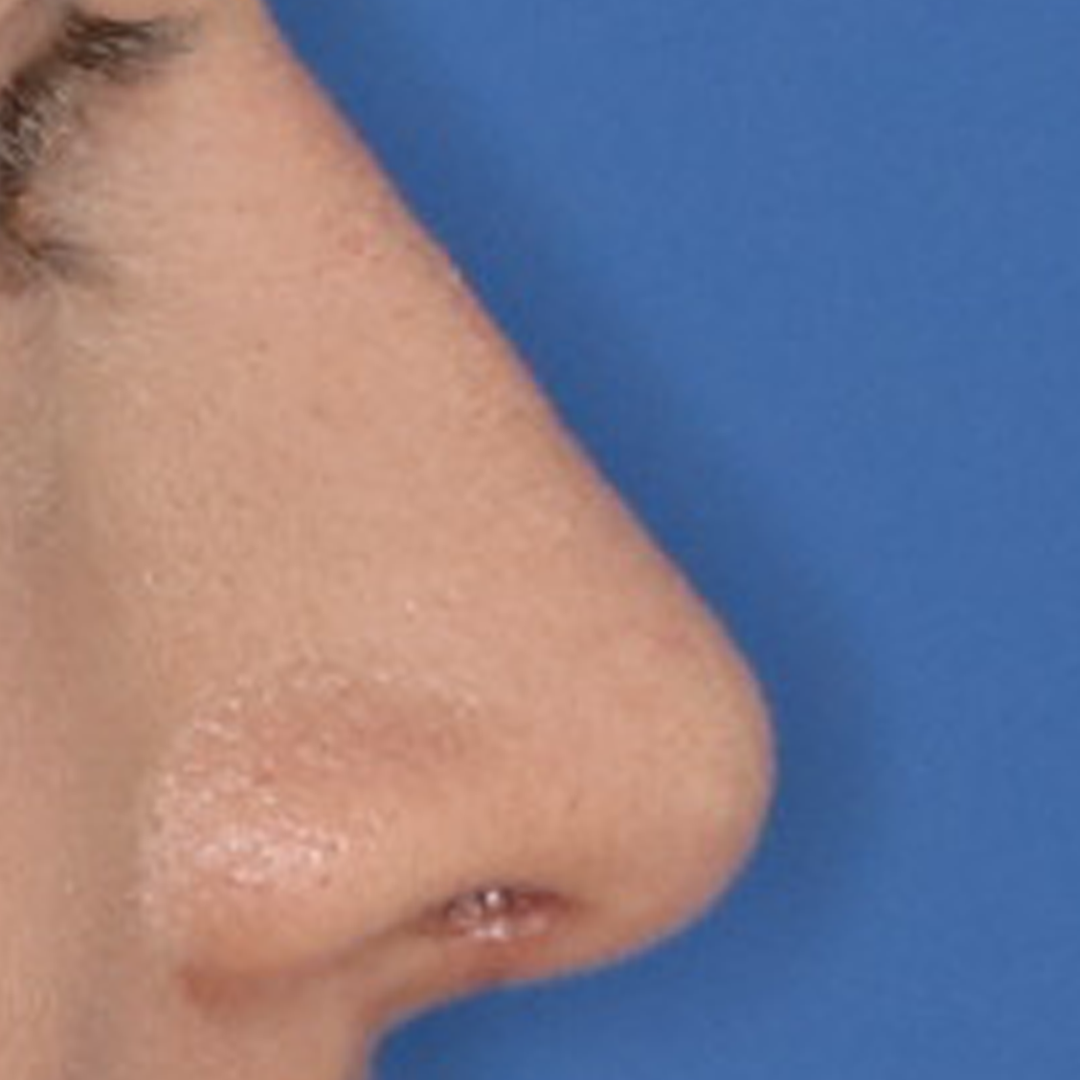 25 year old female's nose close up after receiving a rhinoplasty