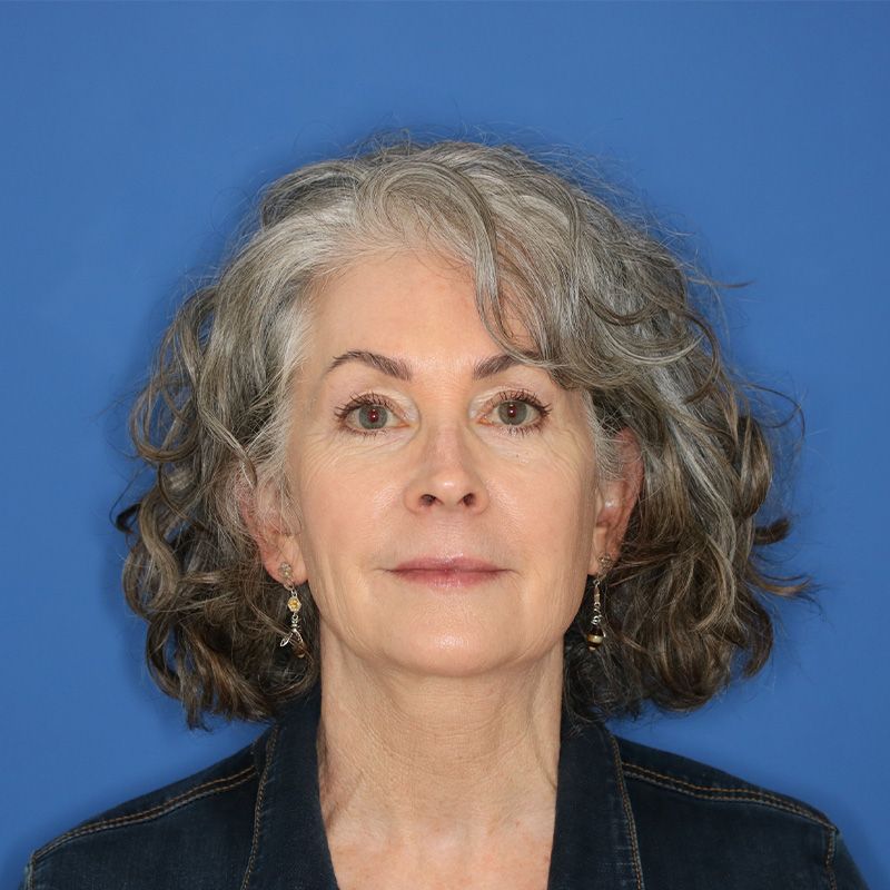 58 year old female underwent upper lip lift in office under local anesthesia.