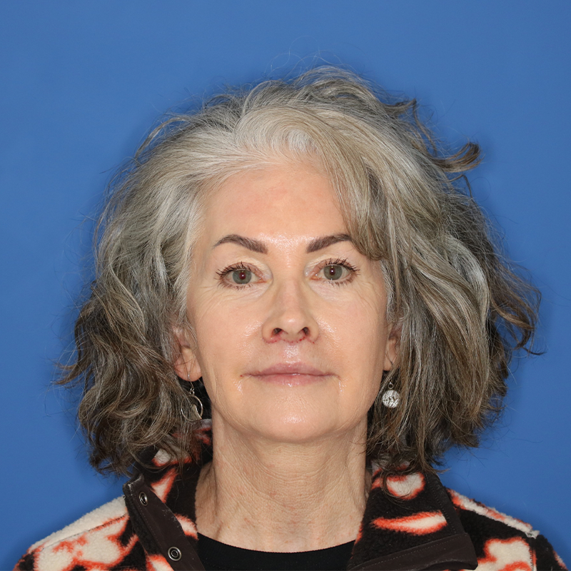 58 year old female underwent upper lip lift in office under local anesthesia.