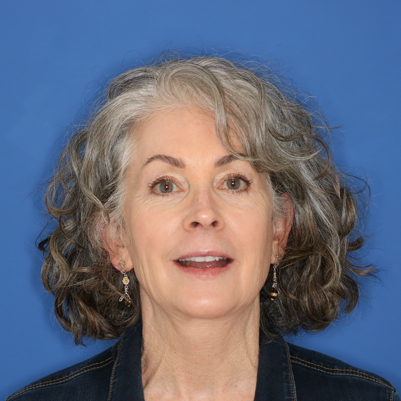 58 year old female underwent a lip lift at the Carson Williams office