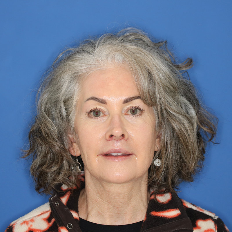 58 year old female underwent upper lip lift in office under local anesthesia.