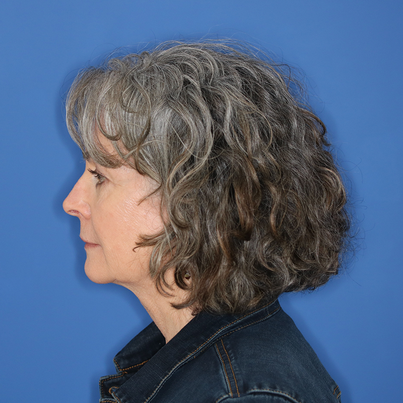 Before female underwent upper lip lift in office