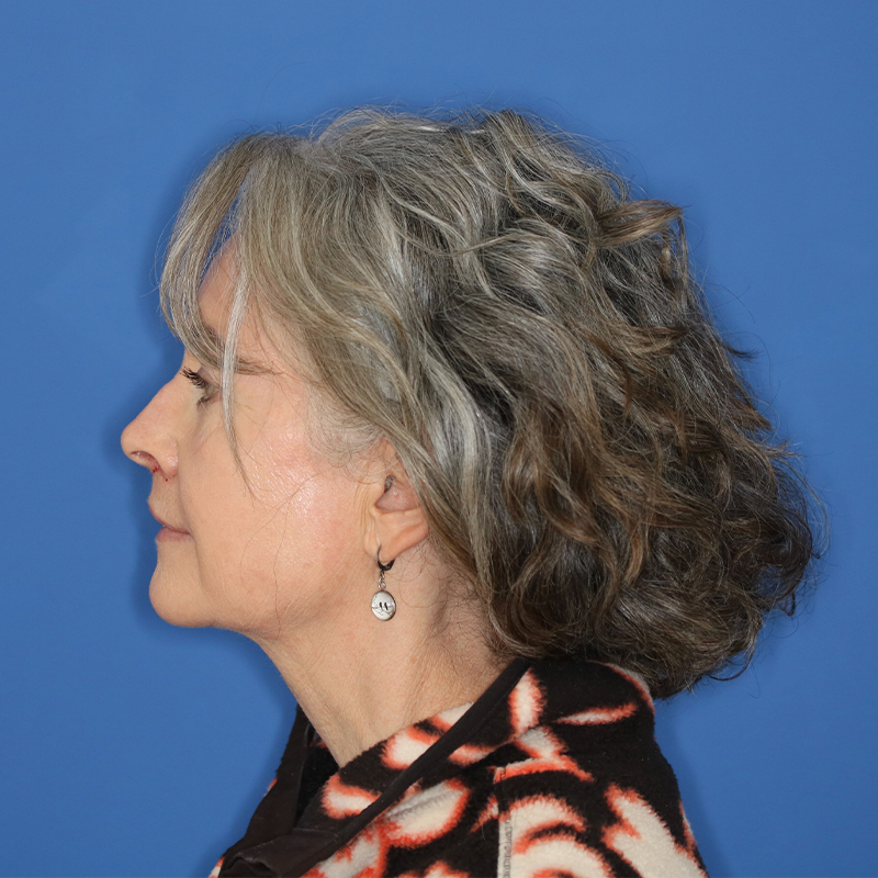 After results of 58 year old female underwent upper lip lift