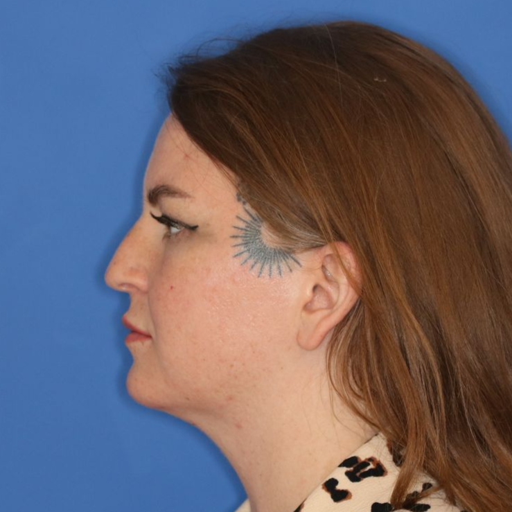 Side profile of a woman before receiving surgery
