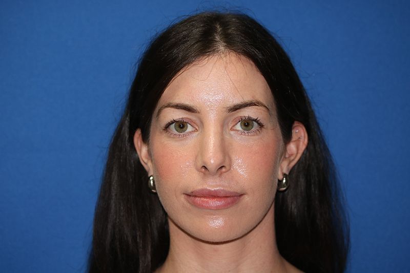 29 year old female who underwent bilateral upper blepharoplasty at Carson Williams Facial Plastic Surgery