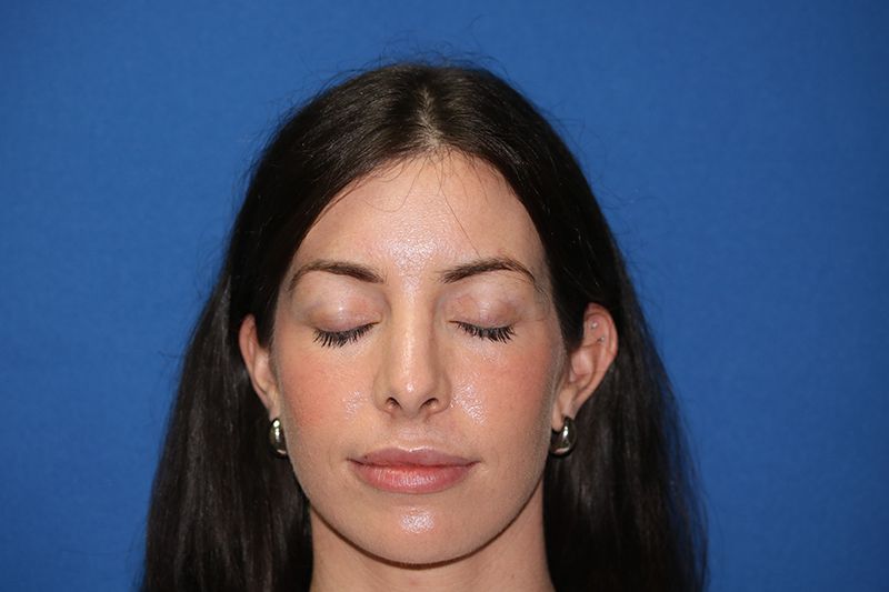 58 year old man who underwent bilateral upper blepharoplasty in office under local anesthesia