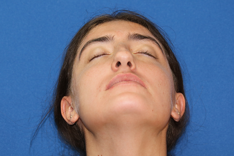 Close up image of a woman's face before rhinoplasty surgery at Carson Williams MD Facial Plastic Surgery office in Leawood KS