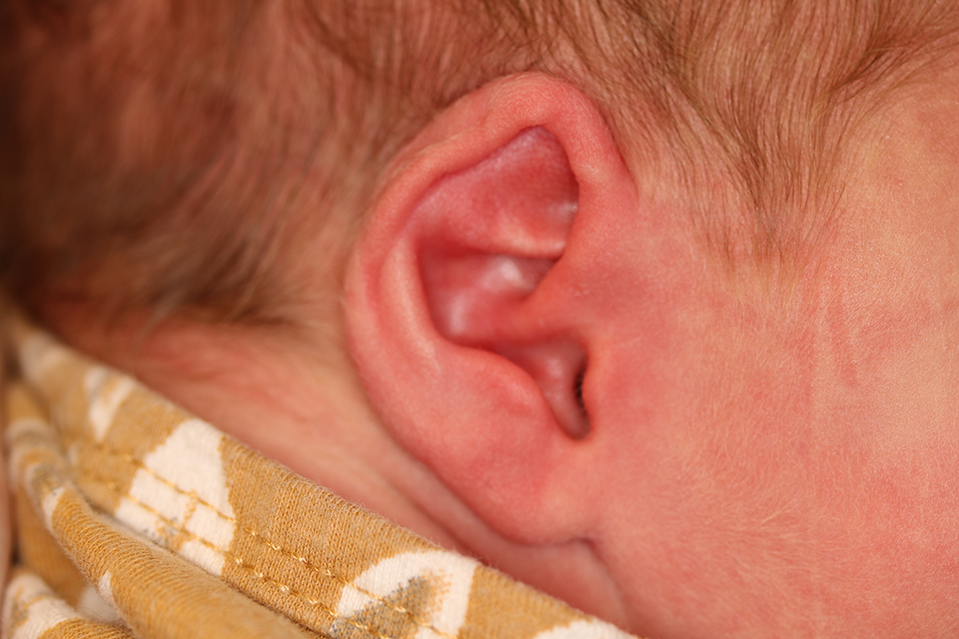Close up of an infant's ear before EarWell Infant Ear Molding at Carson Williams Facial Plastic Surgery in Leawood, KS