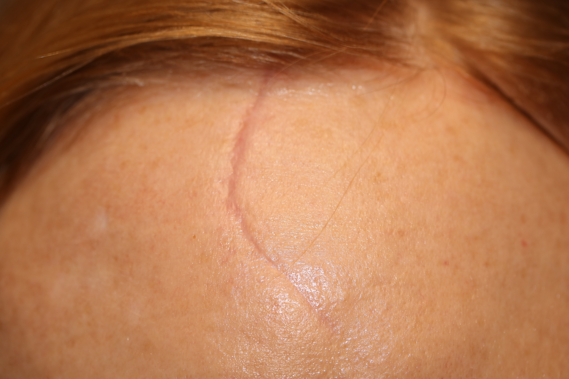 A before picture of a woman who underwent scar treatment at Carson Williams MD Facial Plastic Surgery in leawood, KS