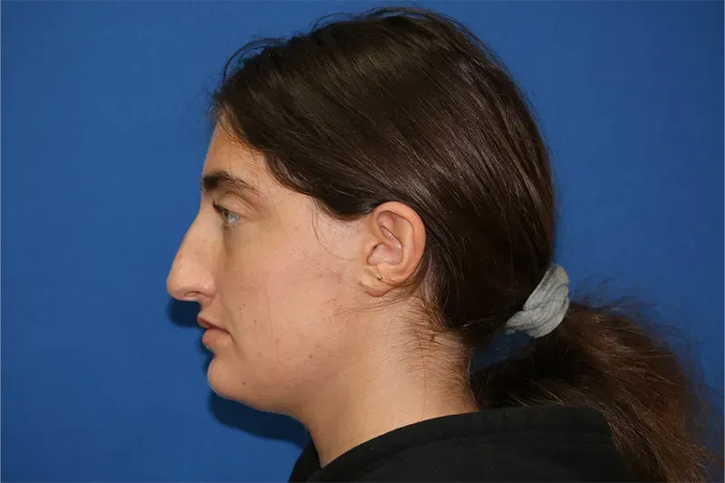 Close up of a woman before Rhinoplasty nose job surgery at Carson Williams Facial Plastic Surgery in Leawood, KS