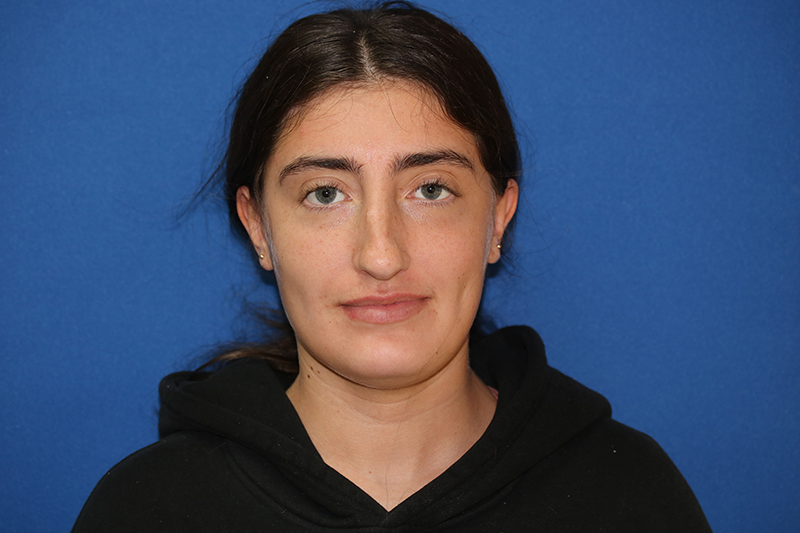 Close up image of a woman's face before rhinoplasty surgery at Carson Williams MD Facial Plastic Surgery office in Leawood KS