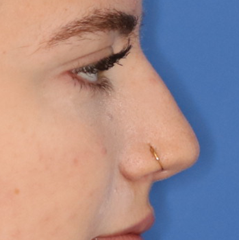 Close up of a woman before liquid rhinoplasty at Carson Williams Facial Plastic Surgery in Leawood, KS