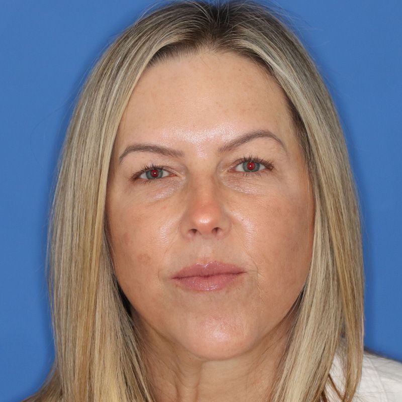 Woman posing for before photos for blepharoplasty surgery