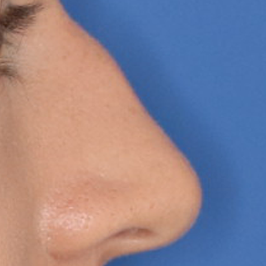 Close up of a 25 year old females nose before receiving a rhinoplasty