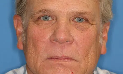 Close up of a man before eyelid surgery at Carson Williams Facial Plastic Surgery in Leawood, KS