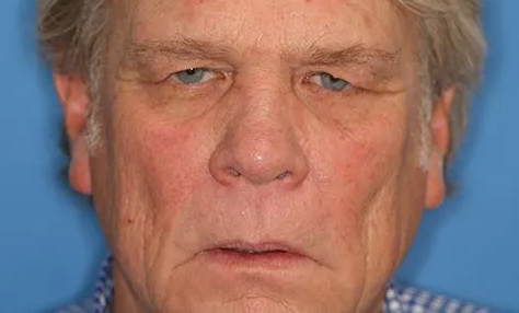 Close up of a man before eyelid surgery at Carson Williams Facial Plastic Surgery in Leawood, KS