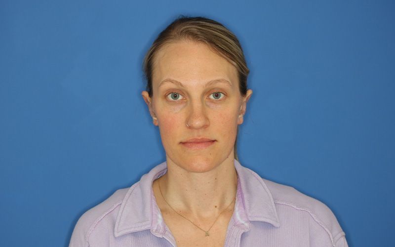 An after picture of a woman who underwent  Otoplasty at Carson Williams MD Facial Plastic Surgery