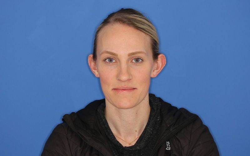 A before picture of a woman who underwent  Otoplasty at Carson Williams MD Facial Plastic Surgery