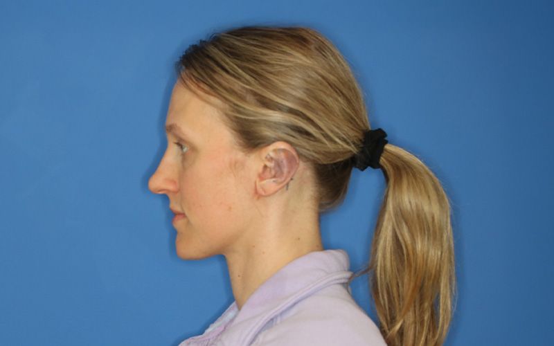 An after picture of a woman who underwent  Otoplasty at Carson Williams MD Facial Plastic Surgery