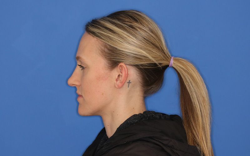 A before picture of a woman who underwent  Otoplasty at Carson Williams MD Facial Plastic Surgery