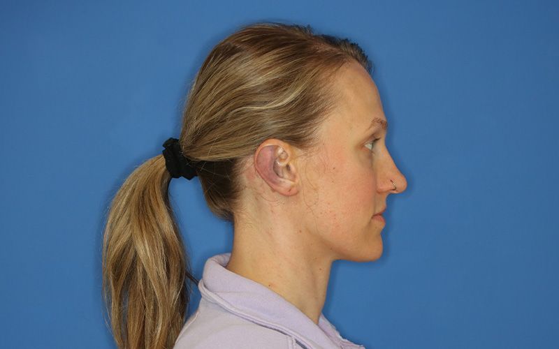 An after picture of a woman who underwent  Otoplasty at Carson Williams MD Facial Plastic Surgery