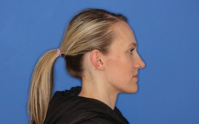 A before picture of a woman who underwent  Otoplasty at Carson Williams MD Facial Plastic Surgery