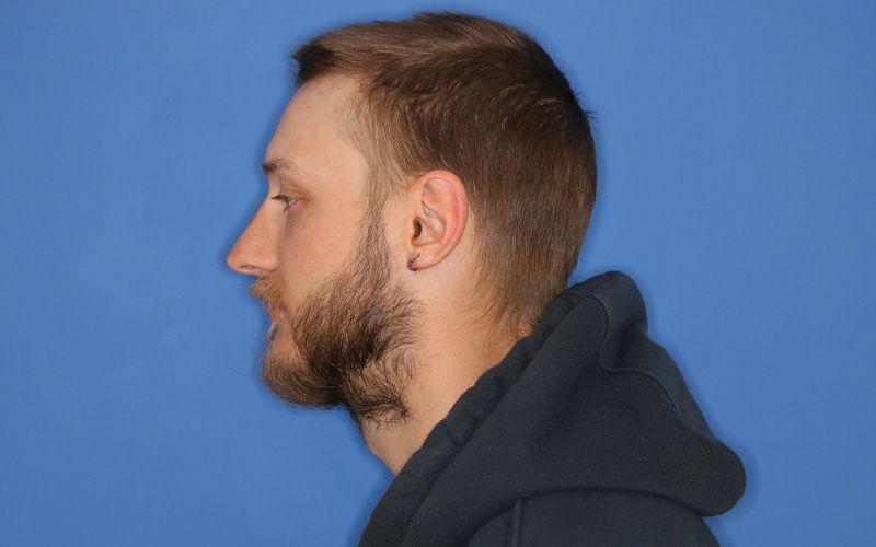 An after  picture of a man who underwent Earlobe Repair at Carson Williams MD Facial Plastic Surgery office in Leawood KS