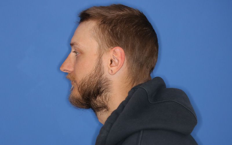 A before picture of a man who underwent Earlobe Repair at Carson Williams MD Facial Plastic Surgery office in Leawood KS