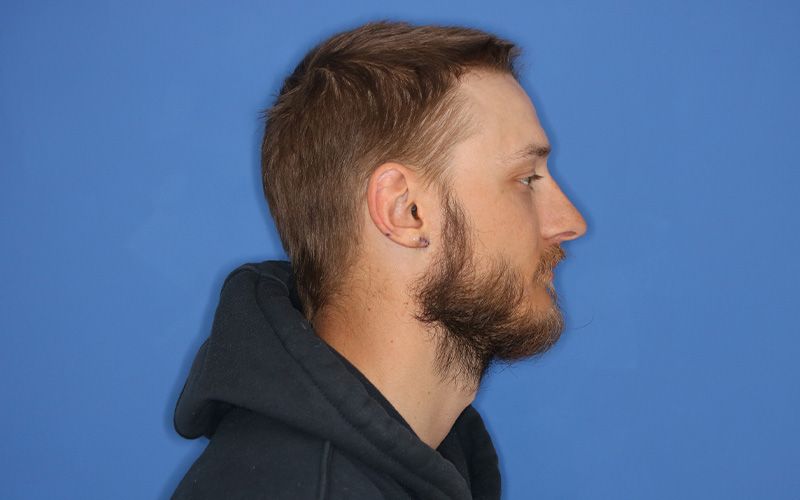 An after  picture of a man who underwent Earlobe Repair at Carson Williams MD Facial Plastic Surgery office in Leawood KS