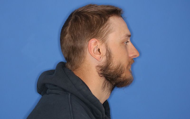 A before picture of a man who underwent Earlobe Repair at Carson Williams MD Facial Plastic Surgery office in Leawood KS