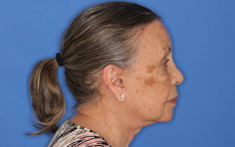 65 year old female underwent deep plane face and neck lift
