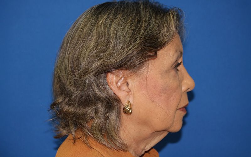 65 year old female underwent deep plane face and neck lift