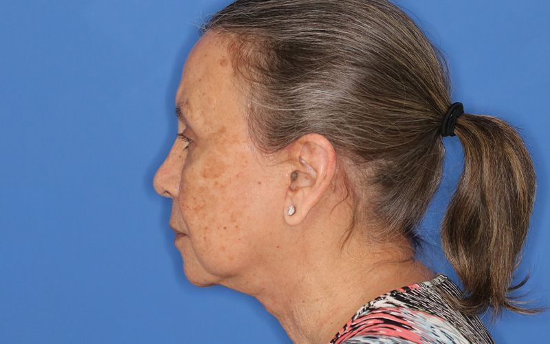 65 year old female underwent deep plane face and neck lift