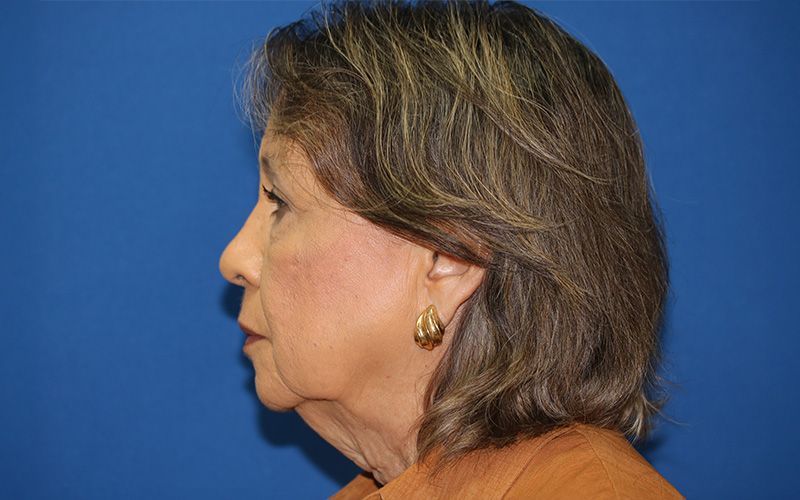 65 year old female underwent deep plane face and neck lift