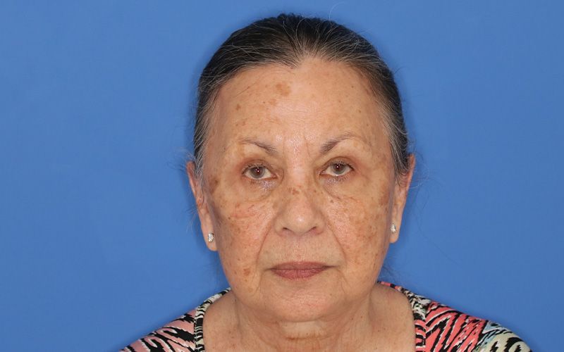 65 year old female underwent deep plane face and neck lift