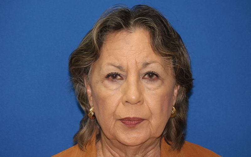 65 year old female underwent deep plane face and neck lift