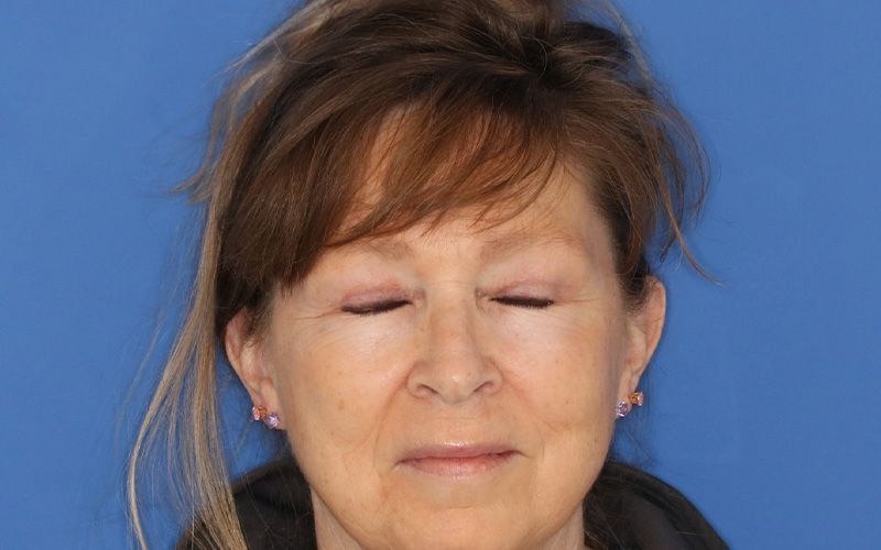 58 year old man who underwent bilateral upper blepharoplasty in office under local anesthesia