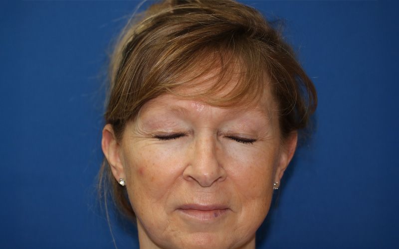 58 year old man who underwent bilateral upper blepharoplasty in office under local anesthesia