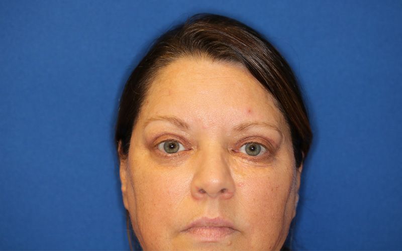 55 year old female who underwent bilateral upper blepharoplasty under local anesthesia in office